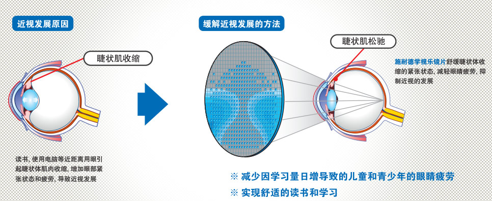 近视发展的原因及缓解方法