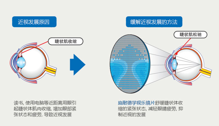 近视发展的原因及缓解方法